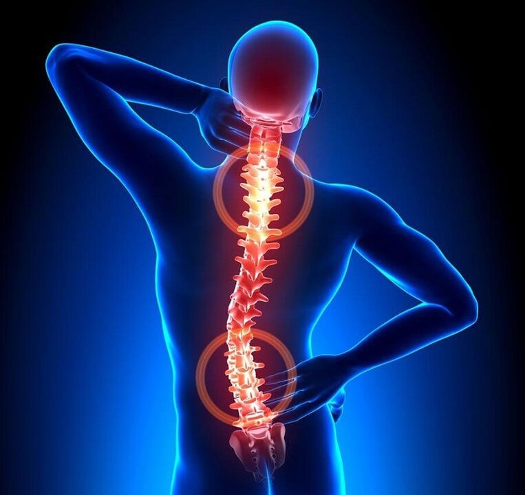 osteohondroza kralježnice kao uzrok bolova u leđima