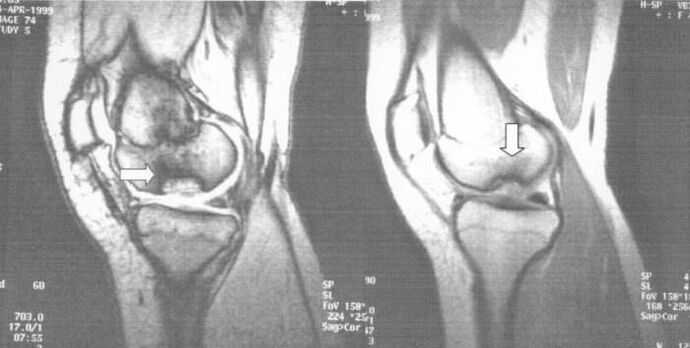 rendgenska disekacija osteohondroze u zglobu koljena