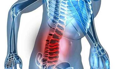 Znakovi i simptomi lumbalne osteohondroze